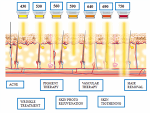IPL &amp; BBL skin rejuvenation in Zurich - Alestetics uses Lumenis M22 for state-of-the-art pigmentation and anti-aging treatments.