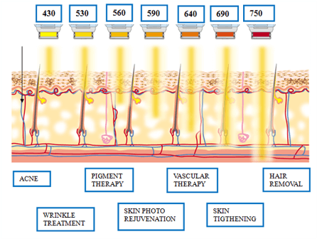 IPL & BBL Hautverjüngung in Zürich – Alestetics nutzt Lumenis M22 für modernste Pigment- und Anti-Aging-Behandlungen.