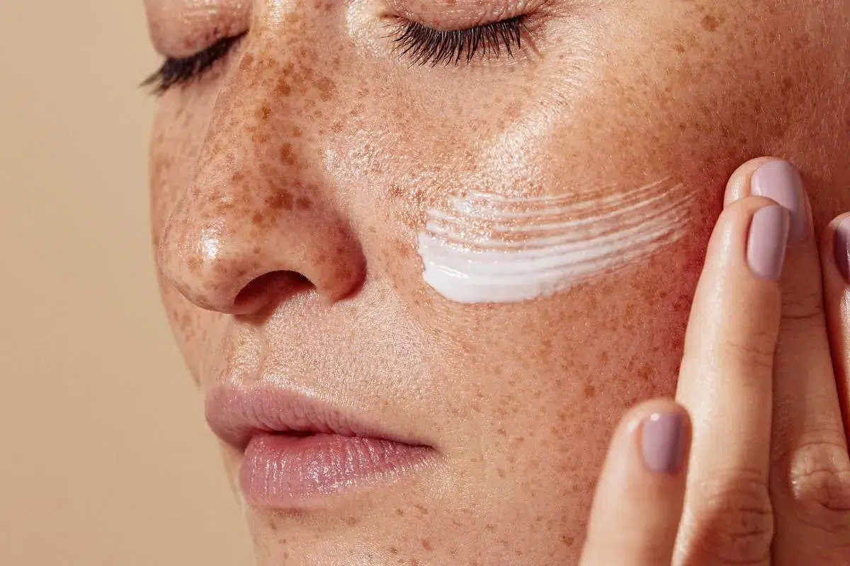 Vivace RF Microneedling Hauttextur Verbesserung Zürich alestetics